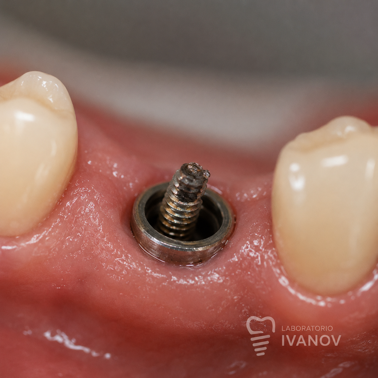 Extracción de Tornillos Rotos en Implantes Dentales | Laboratorio IVANOV